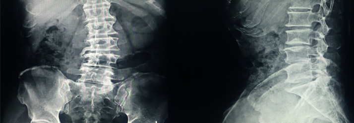 Chiropractic-Monterey-CA-X-Ray-of-a-Spine-Suffering-from-Scoliosis.jpg low back pain relief with chiropractic care