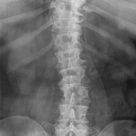 Scoliosis Patient X-Ray Service Box